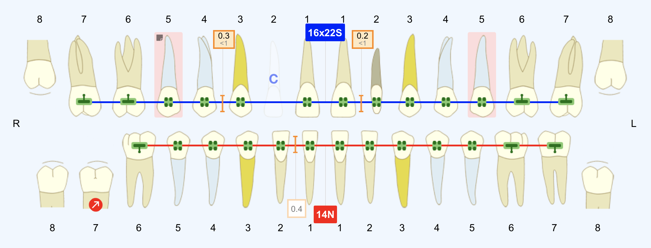 A screenshot of the Tooth Chart with a blue background, indicating that Today's visit is being edited